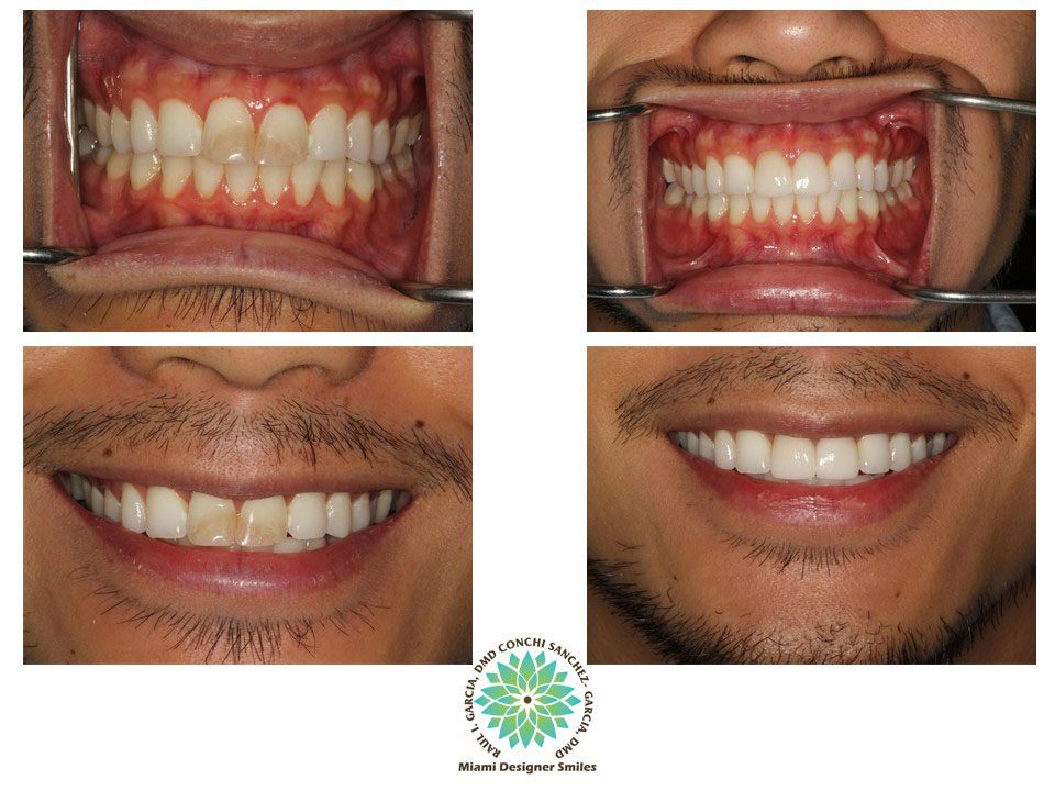 Porcelain Veneers Cosmetic Dentistry Miami Coral Gables