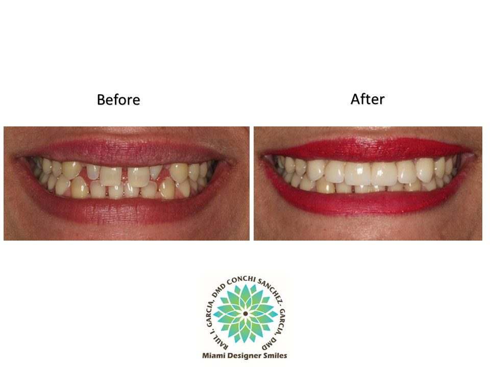 Porcelain Veneers Cosmetic Dentistry Miami Coral Gables