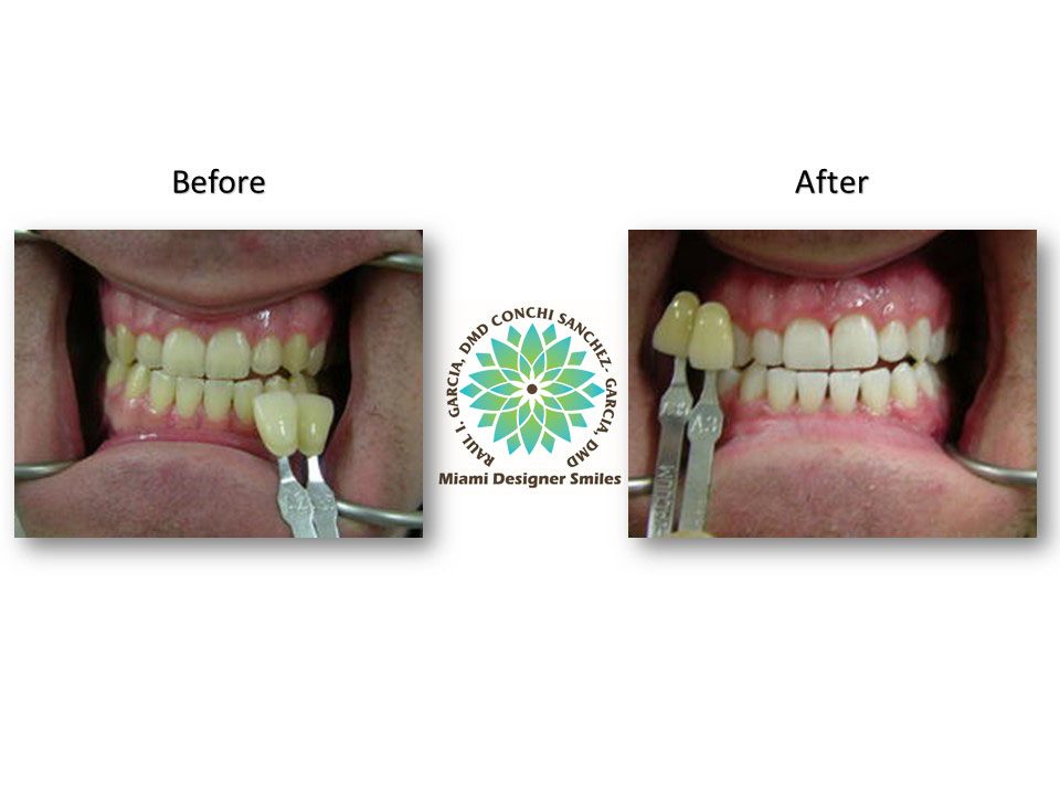 Porcelain Veneers Cosmetic Dentistry Miami Coral Gables