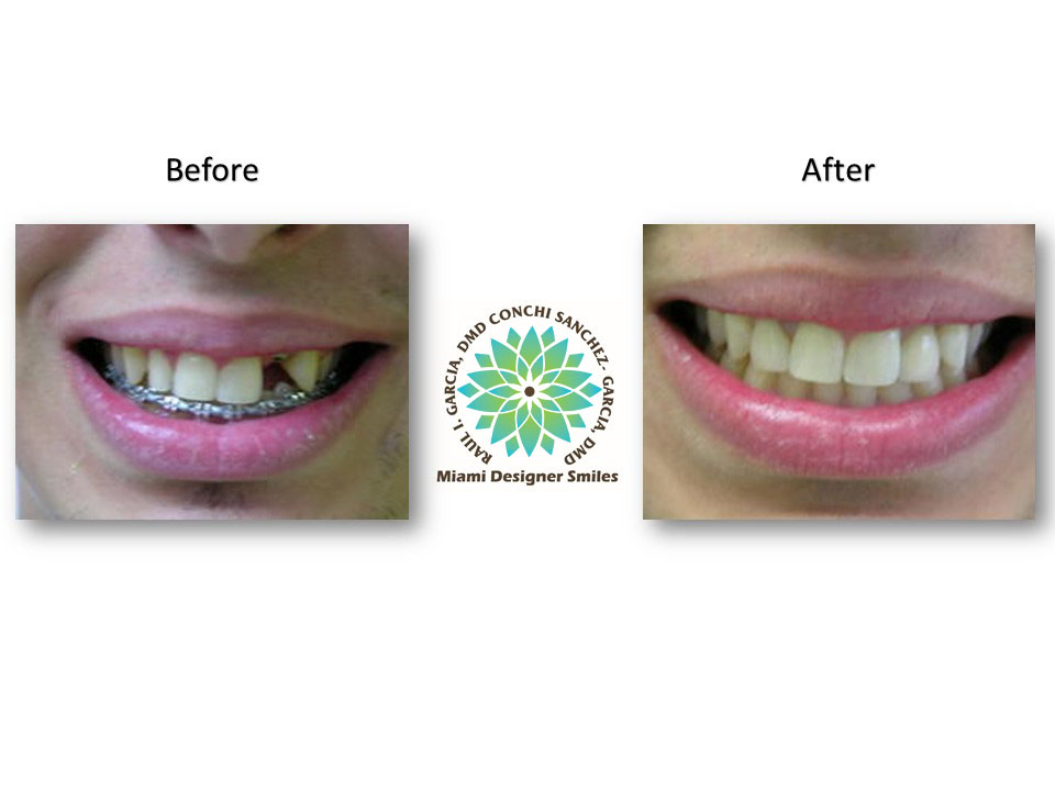 Porcelain Veneers Cosmetic Dentistry Miami Coral Gables